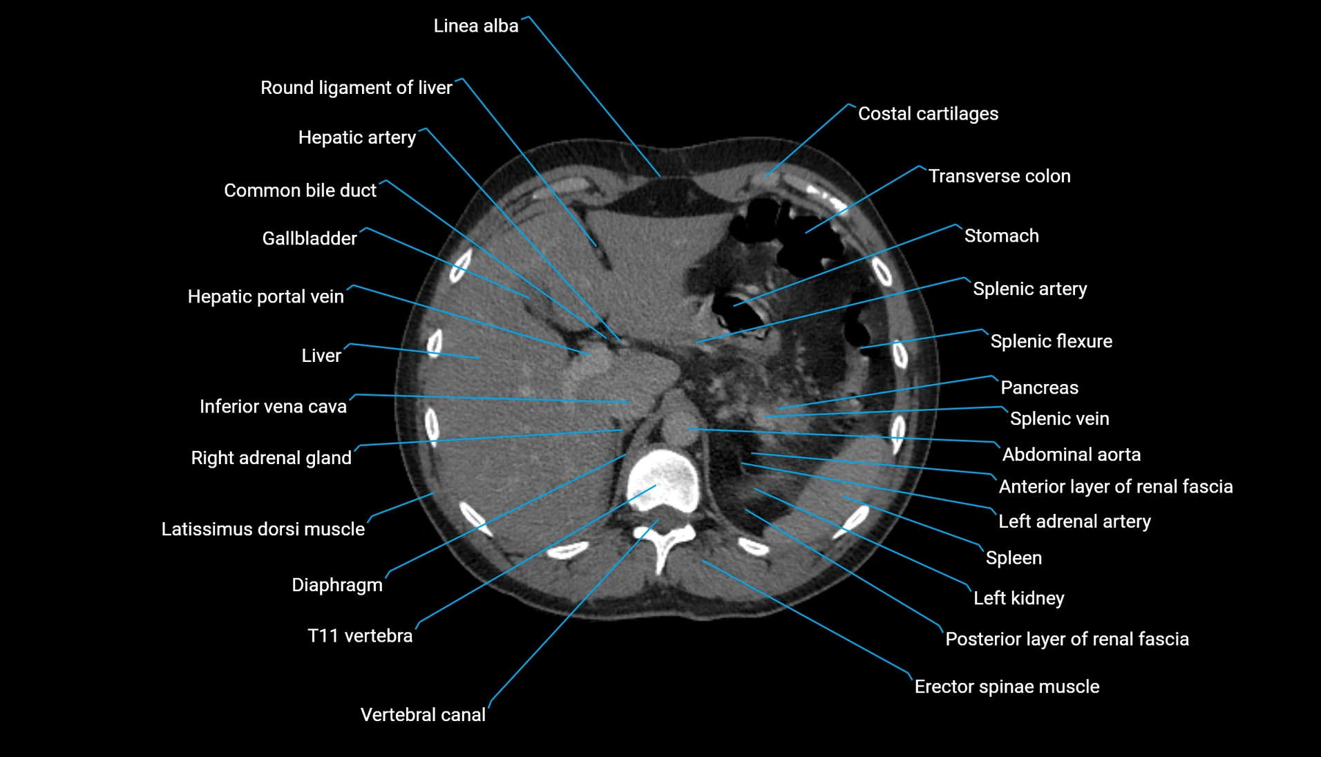 CT urogram axial cross sectional anatomy  labelled radiology image-00070.webp